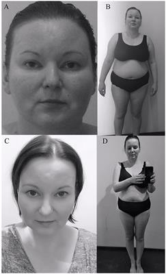 Cushing's Syndrome in a Patient With Rathke's Cleft Cyst and ACTH Cell Hyperplasia Detected by 11C-Methionine PET Imaging—A Case Presentation